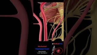 Mechanical Thrombectomy Stroke Animation #Ischemicstroke