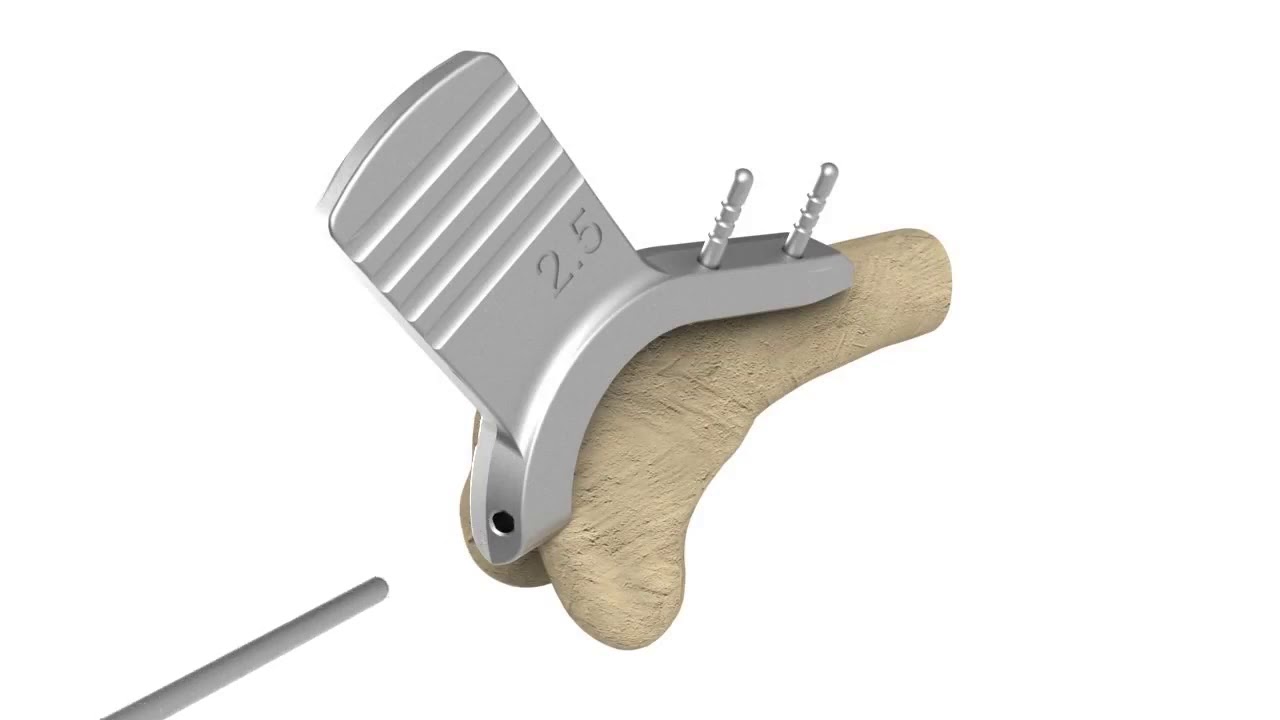 RidgeStop TM surgical technique animation