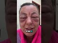 Piqûre d’abeille dans l’œil ? Ne panique pas ! Voici quoi faire#abeille#santé #urgence #œil #conseil