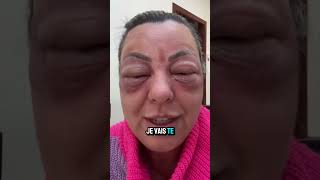 Piqûre d’abeille dans l’œil ? Ne panique pas ! Voici quoi faire#abeille#santé #urgence #œil #conseil