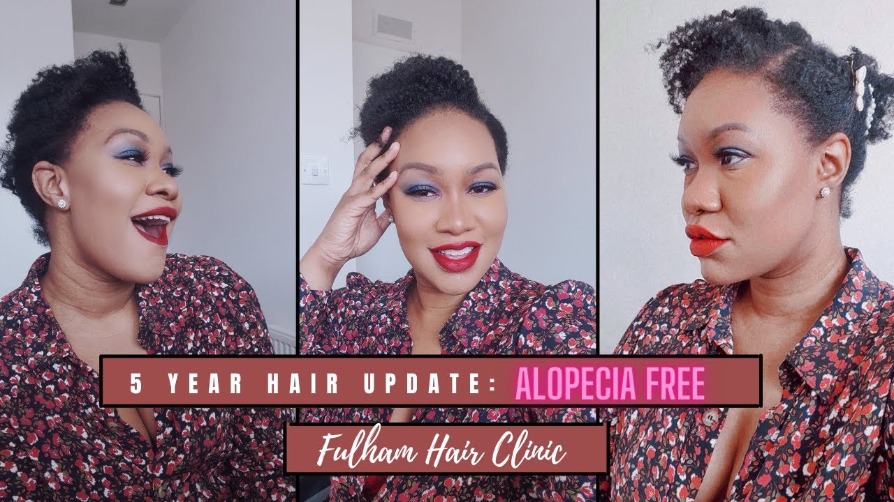 5 Year Hair Update with Fulham Hair Clinic Alopecia Free YouTube