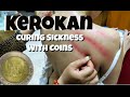 Kerokan | Indonesian Traditional Cure for Sickness