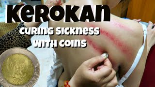 Kerokan | Indonesian Traditional Cure for Sickness