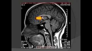 Colloid Cyst (Neuroepithelial Cyst)