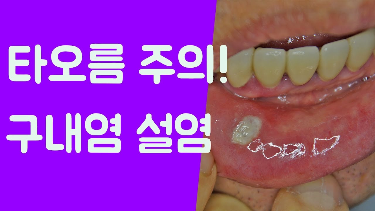 구내염 원인 설염 치료방법 구내염사진 설염사진 대전강남한의원 - YouTube