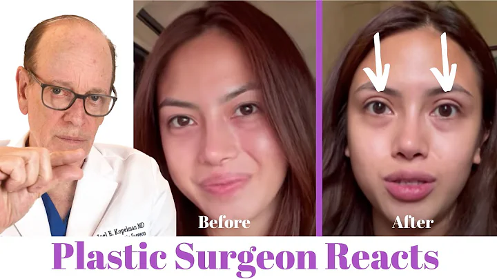 Getting Eyelid Surgery (Blepharoplasty) | Plastic Surgeon Reacts - DayDayNews