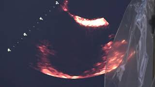 Dr. Daniel Siragusa - University of Florida Vascular and Interventional Radiology - Jacksonville