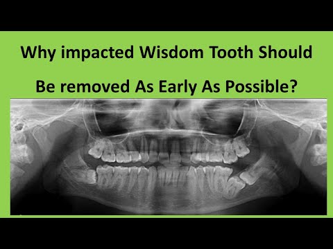 Third Molar Removal Surgery - Why impacted wisdom tooth should be removed?