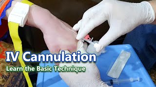 IV Cannulation  Learn the Basic Technique | IV Cannula
