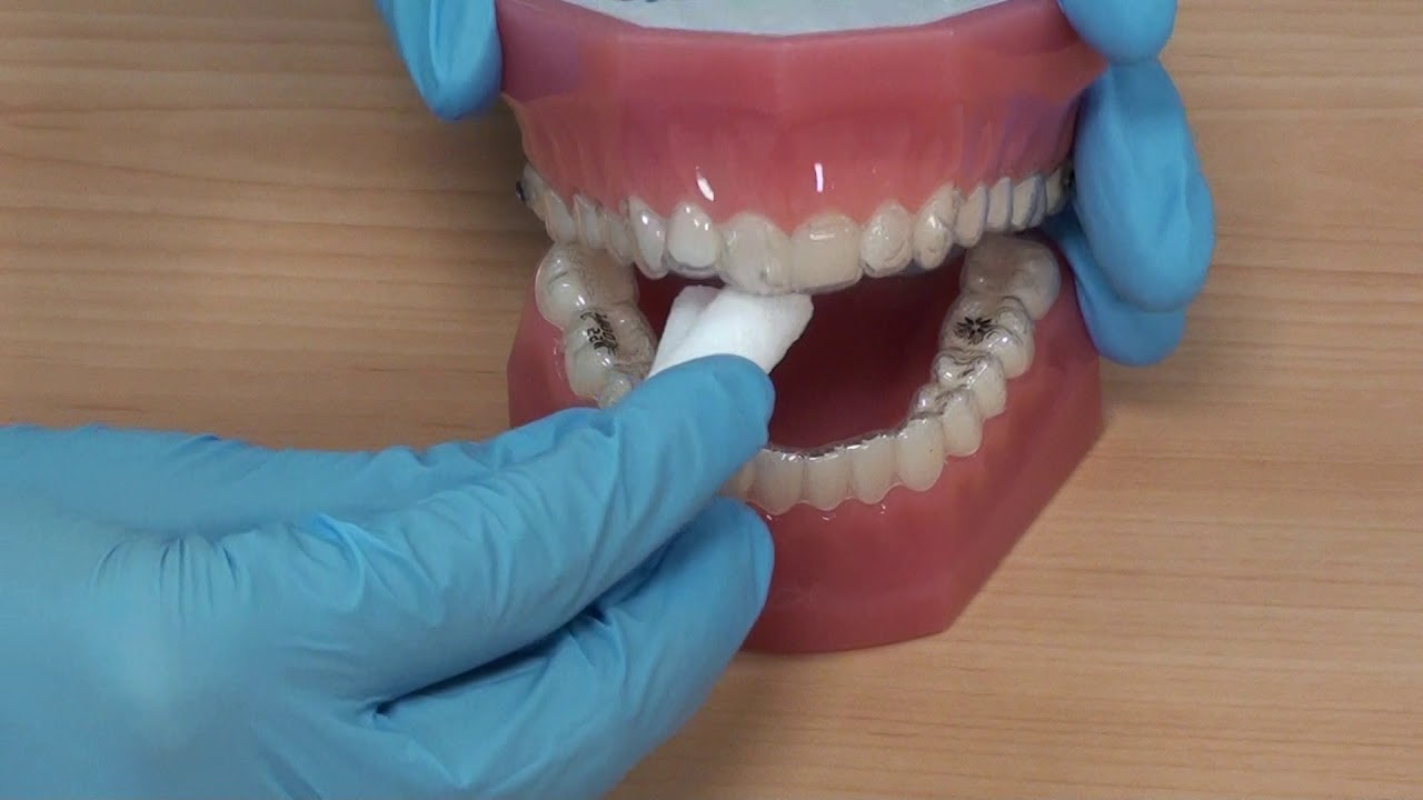 Using Chewies with an anterior open bite.