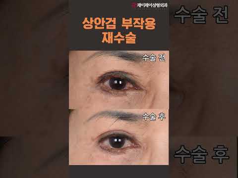 [전후영상] &amp;#39;상안검 부작용 <strong>재수술</strong>&amp;#39; <strong>눈</strong> 성형 영상 - 제이제이성형외과#shorts