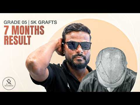 This 7 Month Hair Result is Pure Magic 😳 | Hair Transplant Nagpur | New Roots