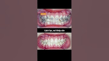 Cận cảnh quá trình niềng răng lệch lạc và sai khớp căn