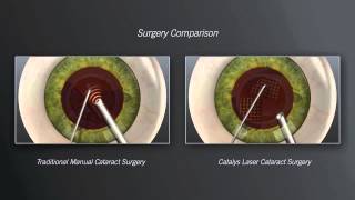 Catalys Laser Cataract Surgery vs. Traditional Manual Cataract Surgery - Animation