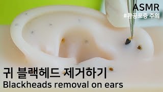 [ASMR] 귀에 딱딱하게 박힌 블랙헤드 제거하기💉｜Remove blackheads from the ears,ブラックヘッド 除去｜블레어 Blair ブレア ASMR
