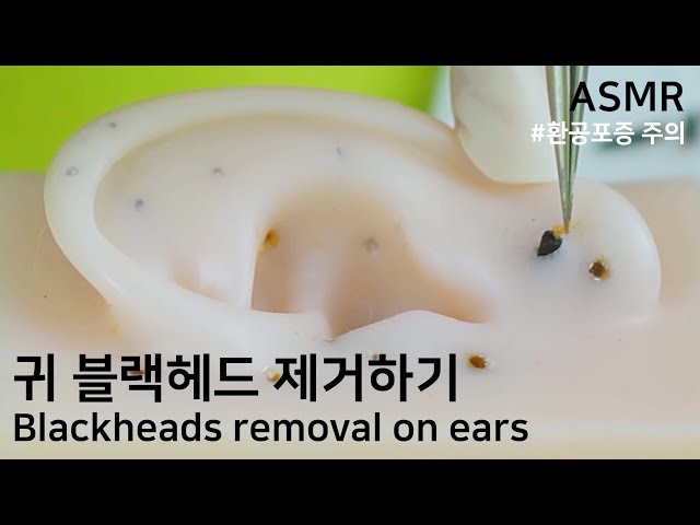 [ASMR] 귀에 딱딱하게 박힌 블랙헤드 제거하기💉｜Remove blackheads from the ears,ブラックヘッド 除去｜블레어 Blair ブレア ASMR