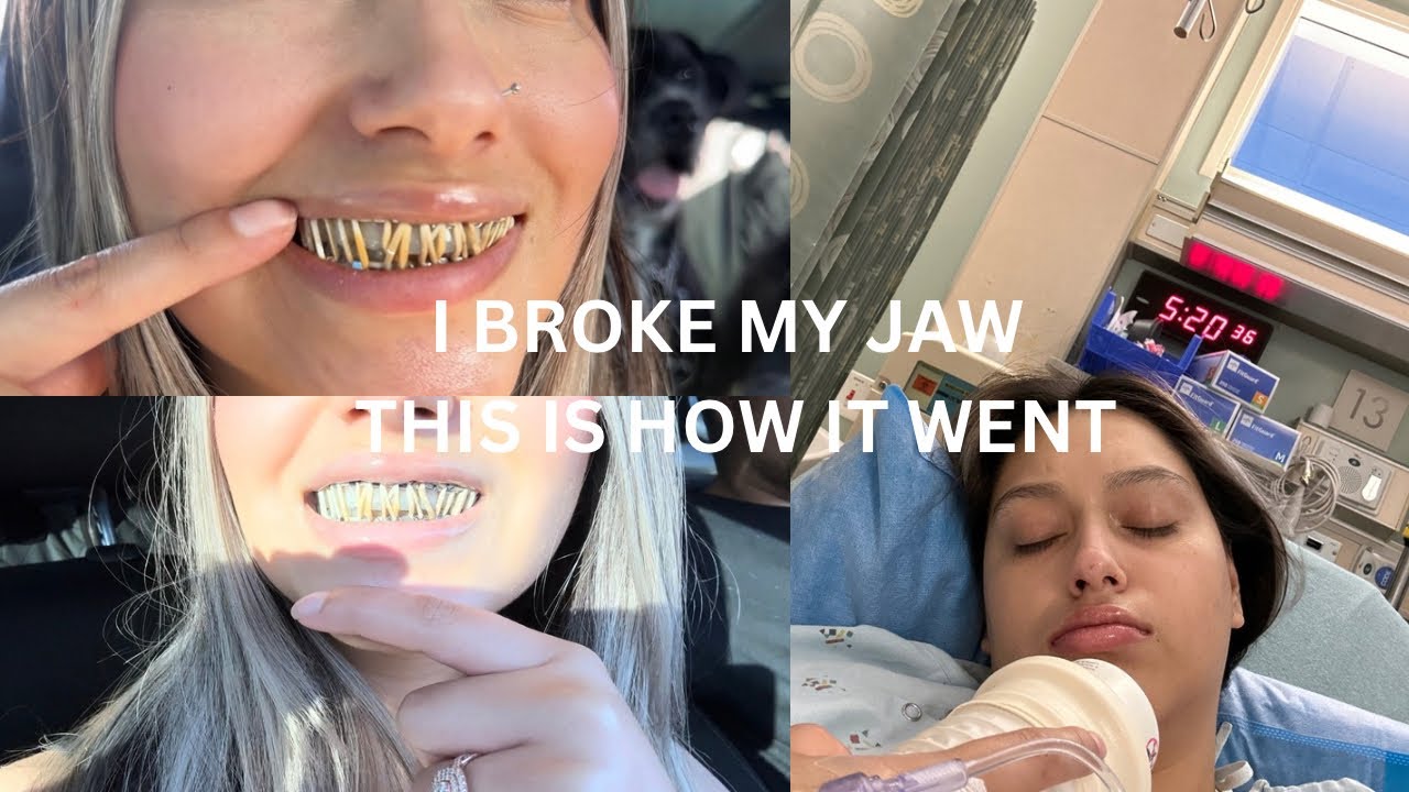 I BROKE MY JAW FULL RECOVERY PROCESS YouTube