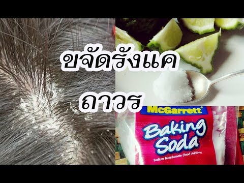 ขจัดรังแค หนังศีรษะแห้ง เห็นผลชัด (dandruff)