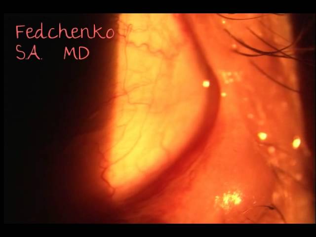 Киста нижнего века