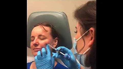 Heather Callahan PA-C injects Juvederm Voluma for ...