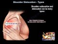 Shoulder Dislocation Types - Everything You Need To Know - Dr. Nabil Ebraheim