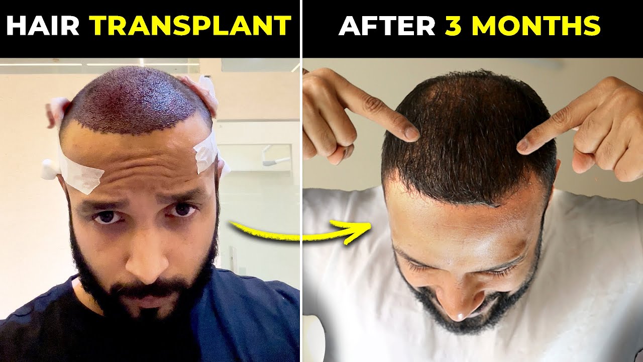 My Hair Transplant RESULTS ✅3 Months* | WHY did I do a Hair Transplant and FUE VS FUT