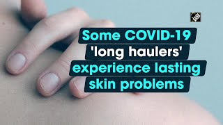 Some COVID-19 'long haulers' experience lasting skin problems