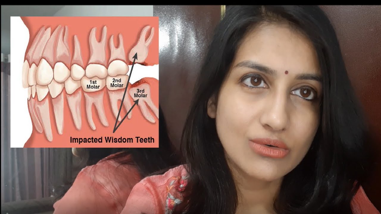 ⁣wisdom tooth pain:cause,symptoms,management,extraction[IN HINDI]