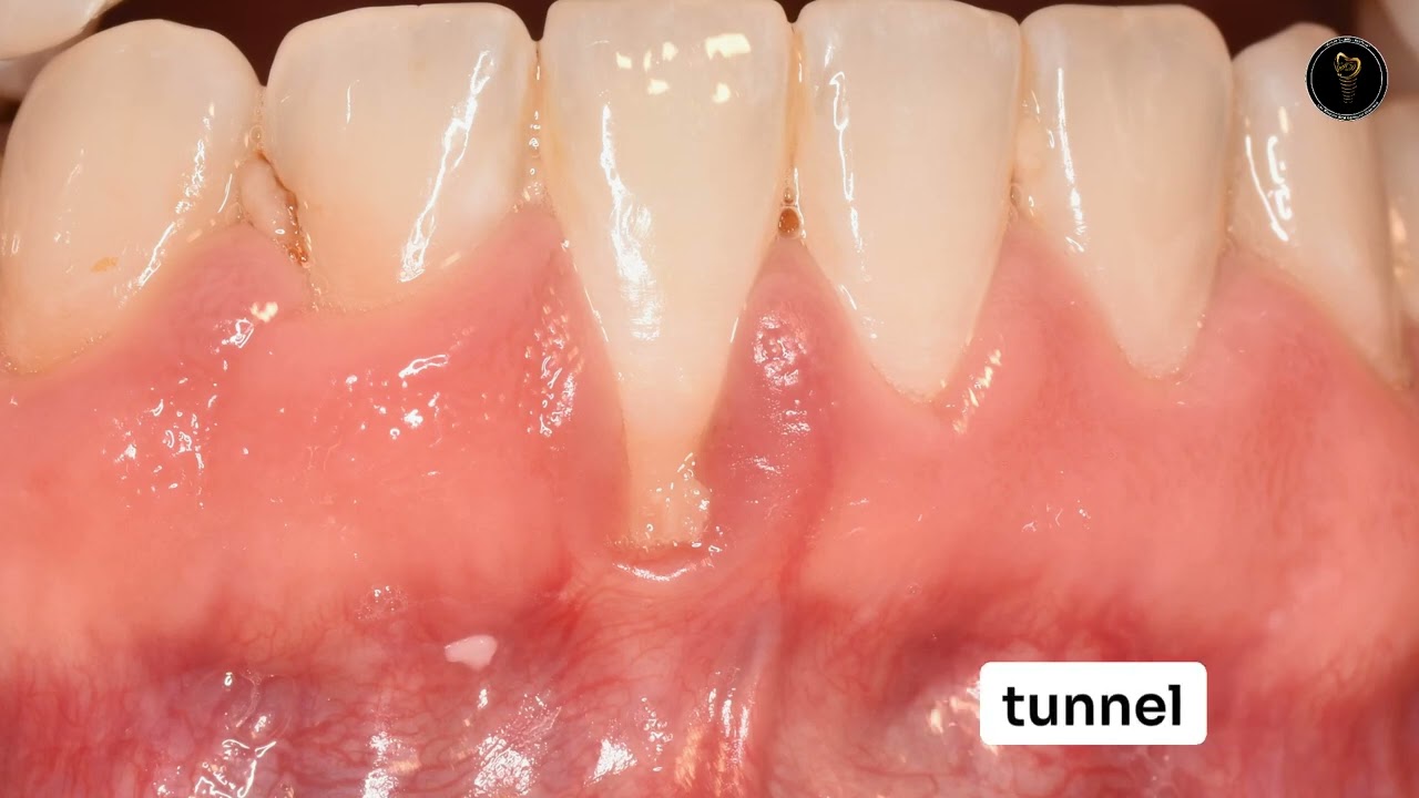 Root Coverage Outcome determinants in soft Tissue Grafting Procedures (CTG)