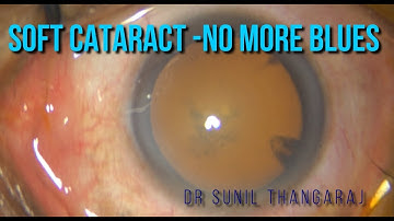 Soft cataract - Nice and Easy  The "Easy Phaco" Tip