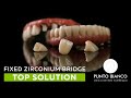 Fixed Zirconium Bridge | Top Solution