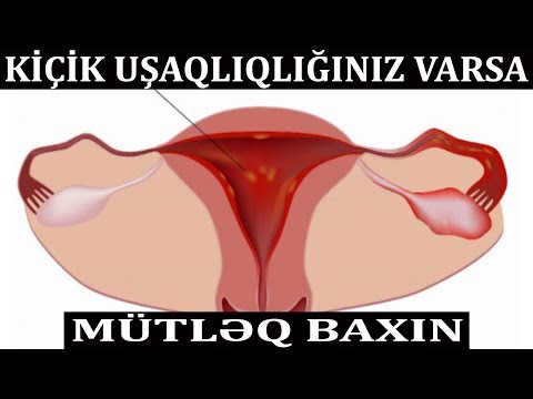 Video: Uşaqlığın ölçüləri fərqlidirmi?