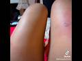 its hurt me than tattoo lol #accidente #foryou #foryourpage
