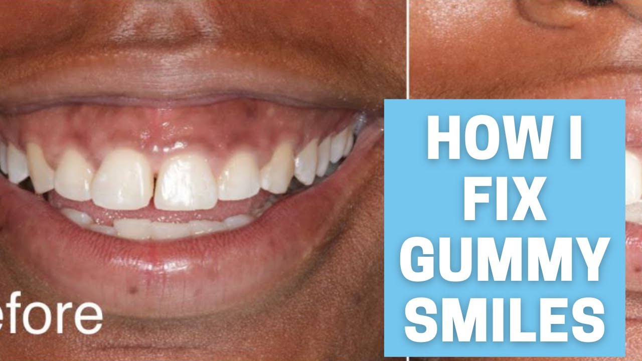 How To Fix Gummy Smiles