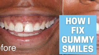How To Fix Gummy Smiles