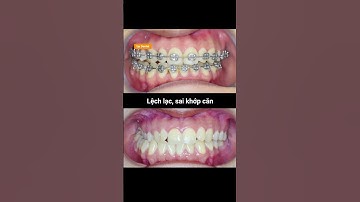 Cận cảnh tiến trình niềng răng lệch lạc và sai khớp cắn