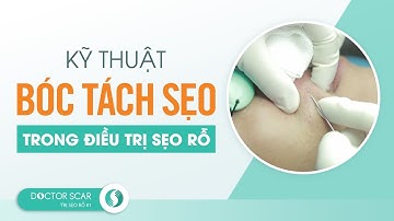 CẬN CẢNH BÁC SĨ THỰC HIỆN BÓC TÁCH SẸO ĐIỀU TRỊ SẸO RỖ