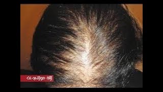 وصفة علاج تساقط شعر و علاج الصلع وتقوية شعر من الامام