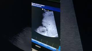 Liver abscess in USG scan