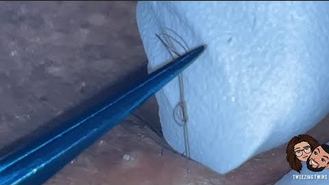 Ingrown Hair Removal Ep28