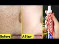 Skin whitening colgate home toothpaste treatments pure beauty tips