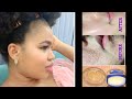 HOW TO USE VASELINE & EGG FOR FACE