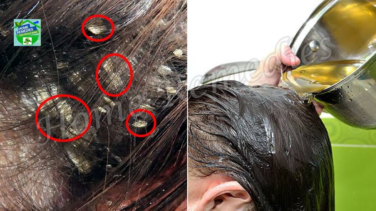 Effective 1Ingredient Home Remedies to Get Rid of Dandruff Naturally