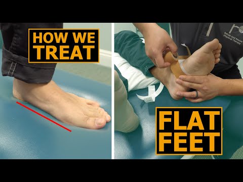Video: Latihan Flat Feet: Mengobati Flat Atau Fallen Arches