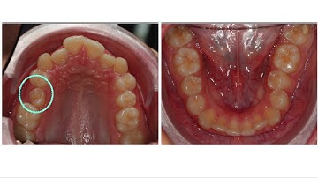 Learn Invisalign. The ultimate protocols to solve severe cases with aligners