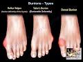 Bunions Types - Everything You Need To Know - Dr. Nabil Ebraheim