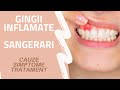 DE CE NE SANGEREAZA GINGIILE? | Gingivita | DR. ANA MARIA OPREA | Ce Sa Fac