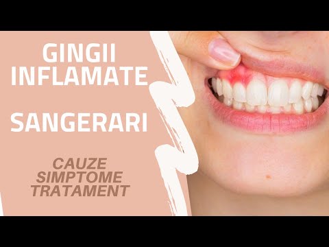 Video: Gingiile Umflate: Cauze, Tratamente și Prevenire