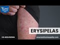 ERYSIPELAS. विसर्प