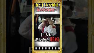 顔に巨大な腫瘍がある女の子の物語#雑学 #shorts